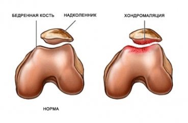 Хондроматоз: колінного суглоба, тазостегнового, що таке хондромних тіло