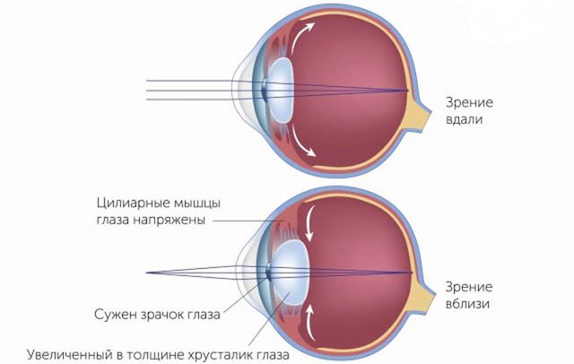 Вроджена міопія (короткозорість) у дітей, лікування високого ступеня у дитини