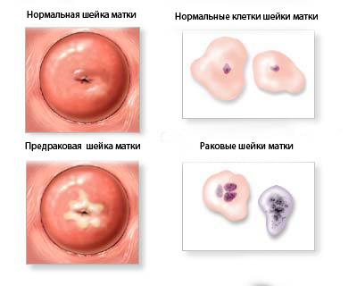 Профілактика раку шийки матки: причини, симптоми, види