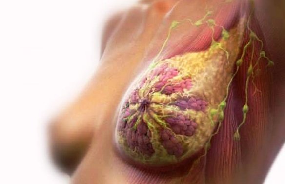 Рак грудини - симптоми, перші ознаки раку молочної залози