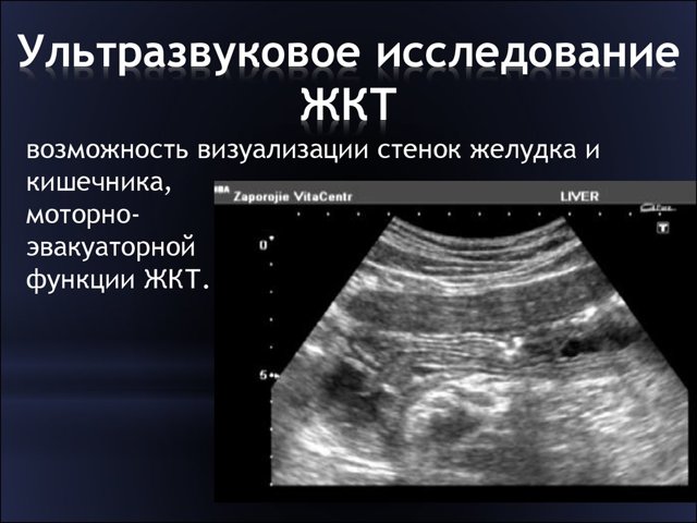 УЗД кишечника або колоноскопія:-яке дослідження краще і інформативніше?