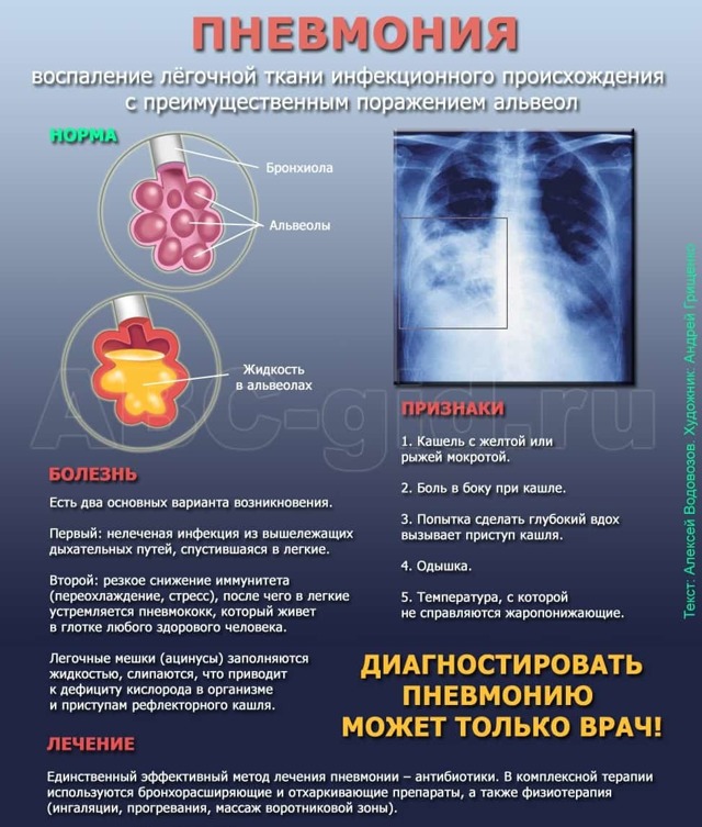 Пневмонія на рентгені - ознаки різних видів запалення легенів