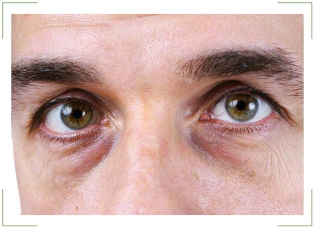 Жовті кола під очима: причини і лікування жовтизни у жінок і чоловіків