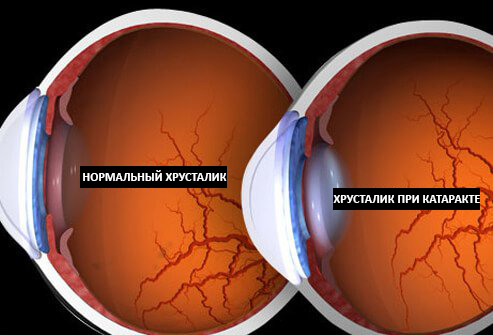 Початкова катаракта: лікування препаратами, що робити, як починається перша стадія, симптоми