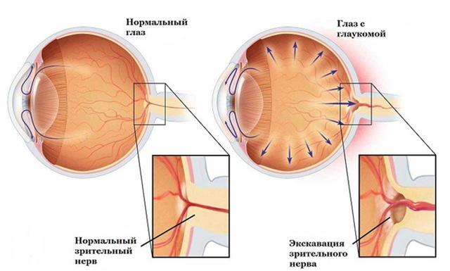 Вроджена глаукома у дітей: фото, причини, симптоми, класифікація