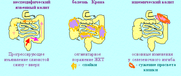 Ішемічний коліт кишечника: симптоми і лікування (дієта, медикаменти, хірургія)