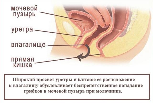 Якщо молочниці і цистит одночасно: способи лікування