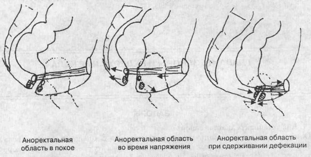 Аноректальная манометр: суть процедури, підготовка і проведення (для пацієнтів)