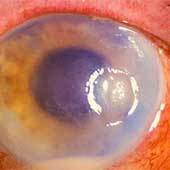 Герпес на оці: лікування очного герпесу на столітті, фото, симптоми, як лікувати