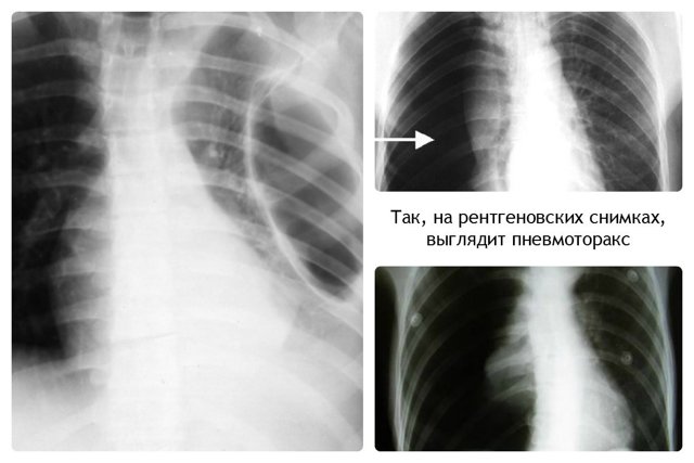 Пневмонія на рентгені - ознаки різних видів запалення легенів