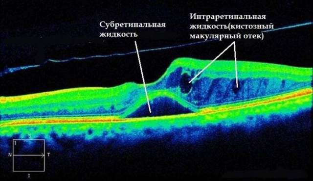 Набряк сітківки ока: лікування, причини, механізм утворення, як лікувати народними засобами