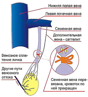 Операція Іваніссевіча: як робиться при варикоцеле на яєчку і показання до операції