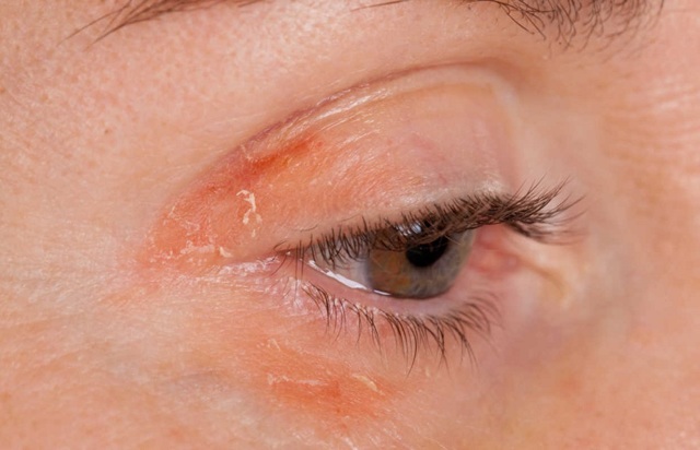 Демодекоз очей: симптоми і лікування очних кліщів на віях у людини, фото