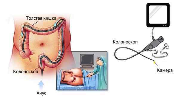 Ендоскопія кишечника: поняття, види, підготовка та проведення