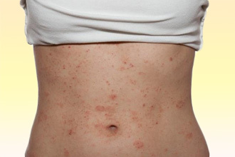 Алергія на синтетику: причини, симптоми і лікування