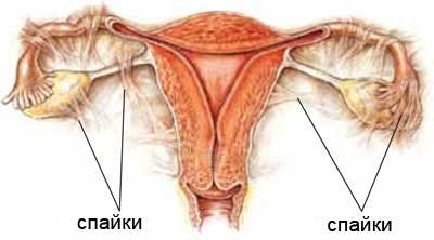 Спайки в малому тазу (спайковий процес): симптоми і способи лікування