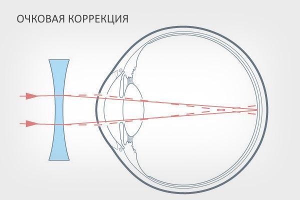 Вроджена міопія (короткозорість) у дітей, лікування високого ступеня у дитини