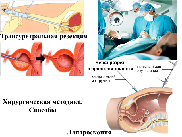 Збільшена простата: що робити, лікування гіпертрофії у чоловіків і причини зростання