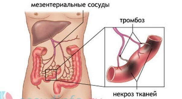 Ішемічний коліт кишечника: симптоми і лікування (дієта, медикаменти, хірургія)