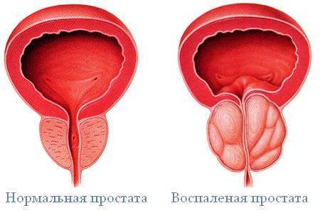 Печіння внизу живота (паху) у чоловіків: причини печіння в інтимній зоні