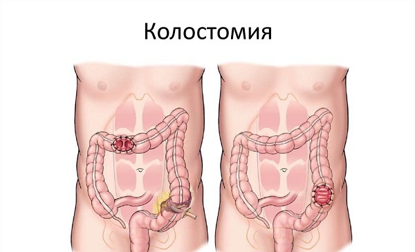 Лікування нетримання калу у літніх жінок і чоловіків: причини появи енкопрез у людей