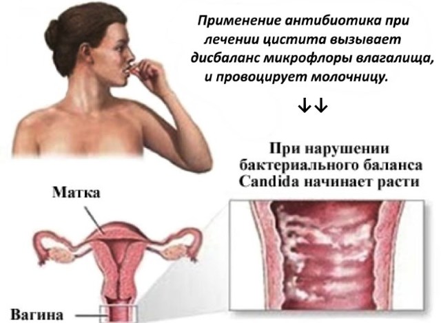 Якщо молочниці і цистит одночасно: способи лікування