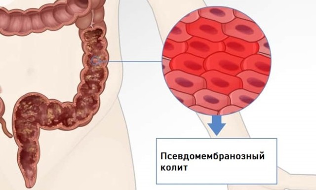 Псевдомембранозний коліт: симптоми і лікування патології