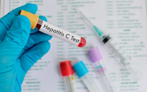 Гострий гепатит: що призводить до захворювання і як лікувати