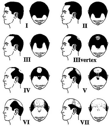 Обласна і тестостерон у чоловіків: вплив на ріст волосся, ознаки, стадії і лікування