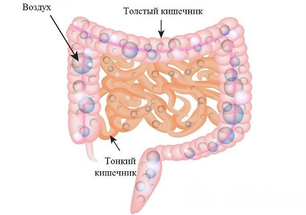 Пневматоз кишечника: симптоми і лікування (дієта, медикаменти, хірургія)