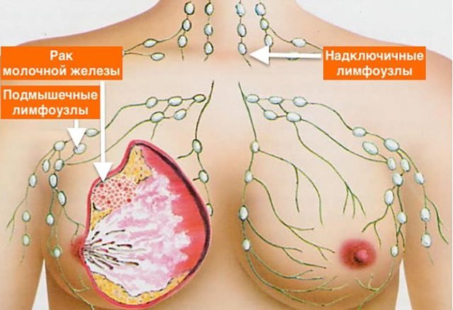 Рак грудини - симптоми, перші ознаки раку молочної залози