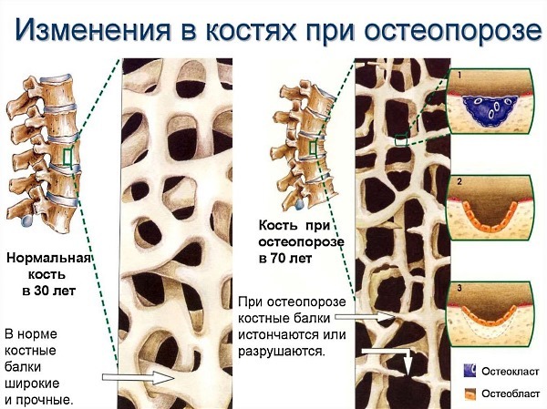 Діагностика остеопорозу у жінок і чоловіків: аналіз крові, денситометрія