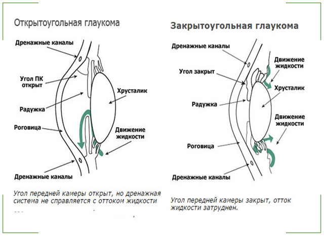 Закритокутова глаукома: причини, симптоми, лікування і профілактика гострих нападів