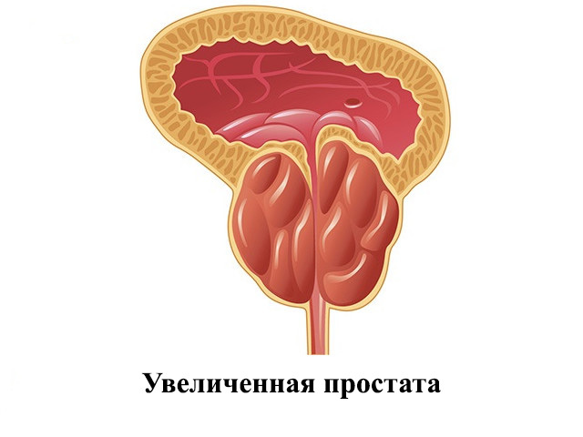 Збільшена простата: що робити, лікування гіпертрофії у чоловіків і причини зростання