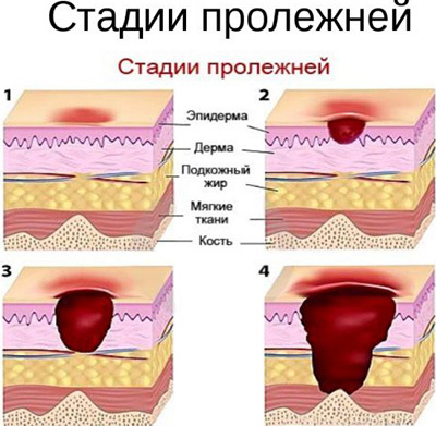 Народні засоби від пролежнів для лежачих хворих: найефективніші способи лікування недуги в домашніх умовах