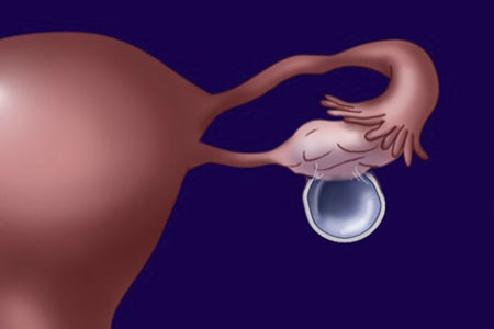 Причини болю в яєчниках у жінок і як лікувати