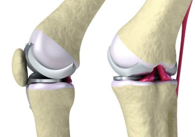 Артроскопія колінного суглоба: що це таке, результативність, показання