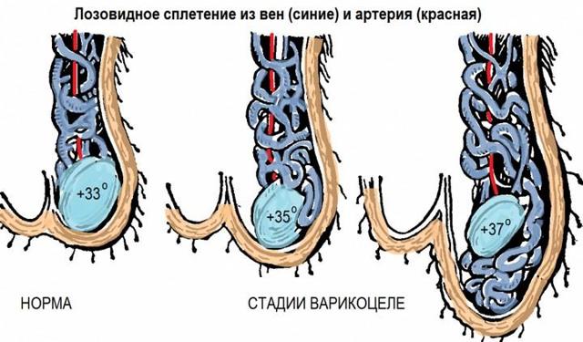 Операція Іваніссевіча: як робиться при варикоцеле на яєчку і показання до операції