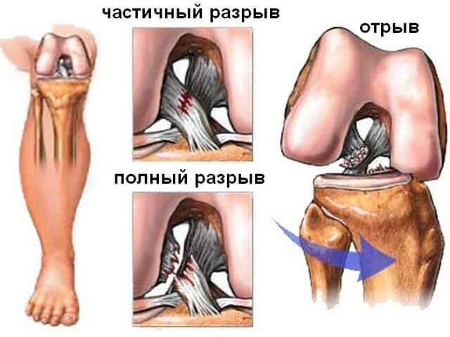 Розрив передньої хрестоподібної зв'язки колінного суглоба: повний, частковий