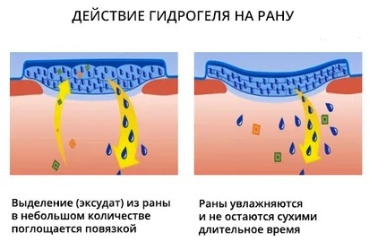 Серветки від пролежнів для лежачих хворих: інструкція із застосування