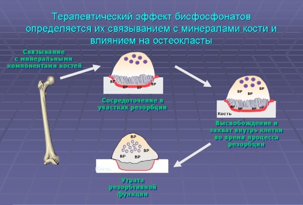 Бісфосфонати для лікування остеопорозу: ефективність, показання, назви препаратів