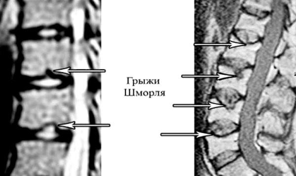 Грижа Шморля поперекового відділу хребта: що це, лікування, симптоми, причини