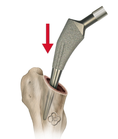 Тэп сустава. Эндопротез тазобедренного сустава. Эндопротез w-655361. Implantcast тазобедренный сустав. Протез Aesculap тазобедренного сустава TRJ Press-Fit.